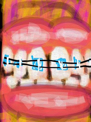 BRACES