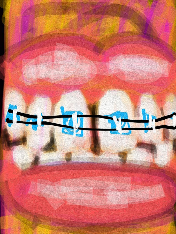 BRACES