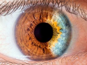 NATURAL HETEROCHROMIA